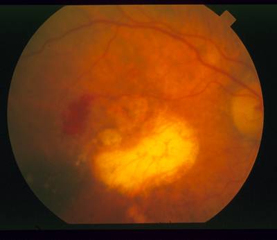 Sample image from STARE