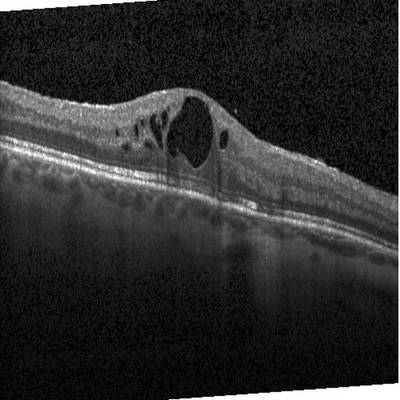 Sample image from Intraretinal Cystoid Fluid