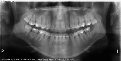 Sample image from Teeth Segmentation on Dental X-ray Images