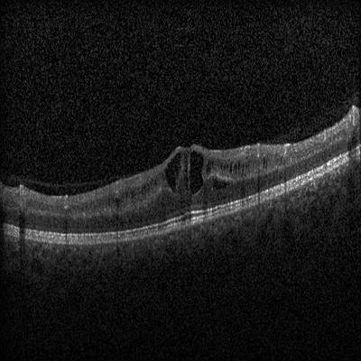 Sample image from Intraretinal Cystoid Fluid