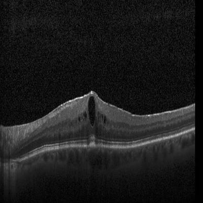 Sample image from Intraretinal Cystoid Fluid