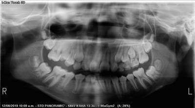 Sample image from Teeth Segmentation on Dental X-ray Images