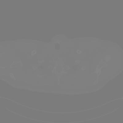 Sample image from DeepLesion