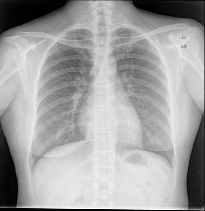 Sample image from Chest Xray Masks and Labels