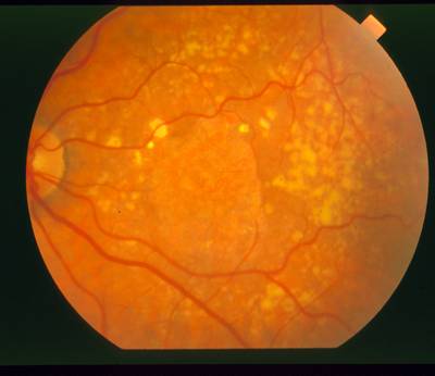 Sample image from STARE