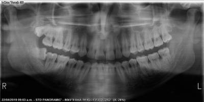 Sample image from Teeth Segmentation on Dental X-ray Images