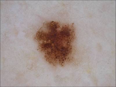 Sample image from ISIC 2017: Part 1 - Lesion Segmentation