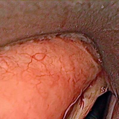 Sample image from Laryngeal Endoscopic