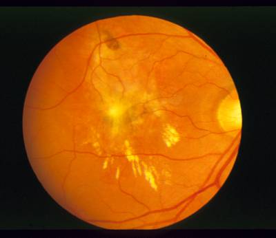 Sample image from STARE