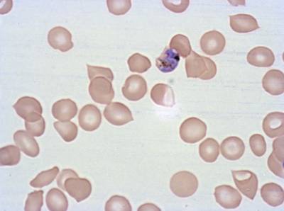 Sample image from Plasmodium Falciparum from Images of Giemsa for Malaria Detection