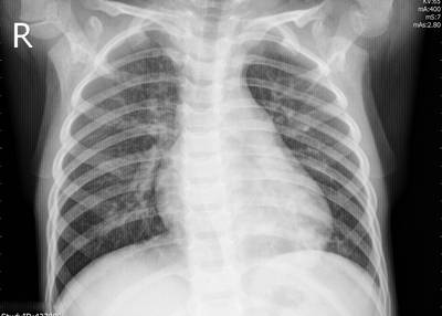 Sample image from ZhangLabData: Chest X-Ray
