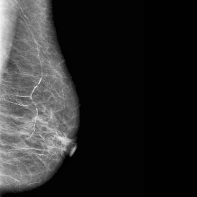 Sample image from CBIS-DDSM