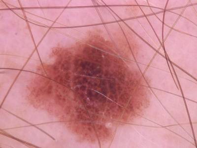 Sample image from Skin Cancer: HAM10000