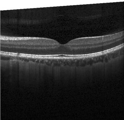 Sample image from ZhangLabData: OCT