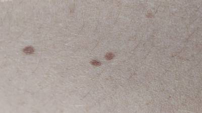 Sample image from Accurate Nevus Shapes