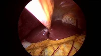 Sample image from CholecSeg8k