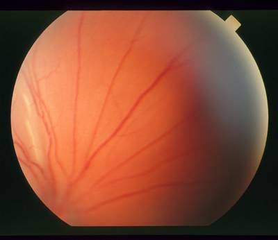 Sample image from STARE