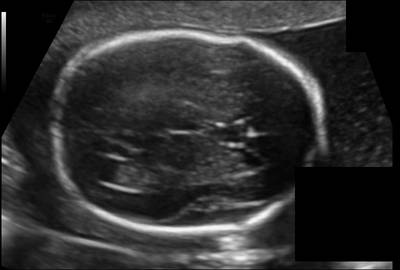 Sample image from Fetal Head UltraSound