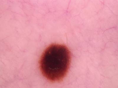 Sample image from Skin Cancer: HAM10000