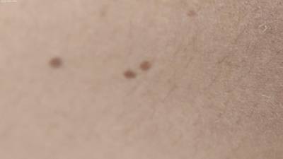 Sample image from Accurate Nevus Shapes