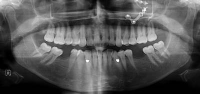 Sample image from Panoramic Dental X-rays