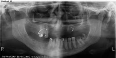 Sample image from Teeth Segmentation on Dental X-ray Images