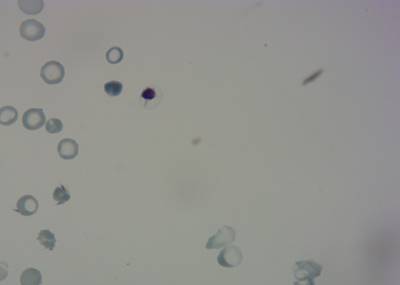 Sample image from P. Vivax (Malaria) Infected Human Blood Smears