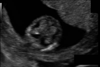 Sample image from Fetal Head UltraSound
