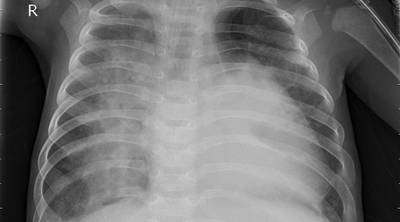 Sample image from ZhangLabData: Chest X-Ray