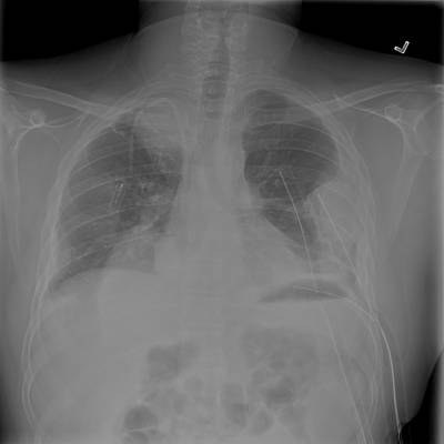 Sample image from SIIM-ACR Pneumothorax Segmentation 2019