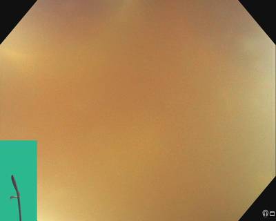 Sample image from PolypGen