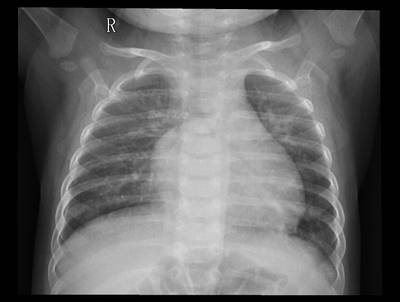Sample image from ZhangLabData: Chest X-Ray