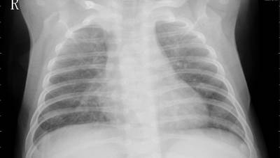 Sample image from ZhangLabData: Chest X-Ray