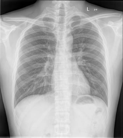 Sample image from Chest Xray Masks and Labels