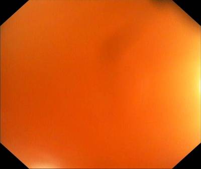 Sample image from PolypGen