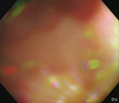 Sample image from PolypGen