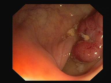 Sample image from CVC-ClinicDB