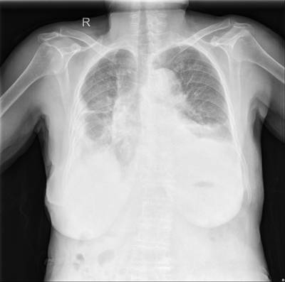 Sample image from Chest Xray Masks and Labels