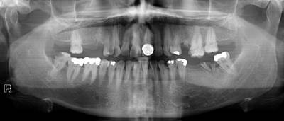 Sample image from Panoramic Dental X-rays