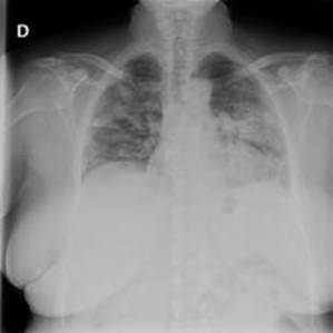 Sample image from COVID-19