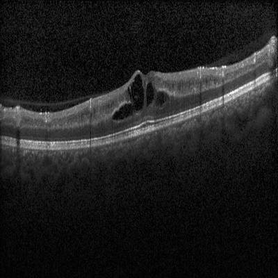 Sample image from Intraretinal Cystoid Fluid