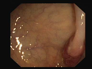 Sample image from CVC-ClinicDB