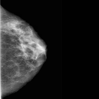 Sample image from CBIS-DDSM