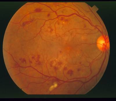 Sample image from STARE