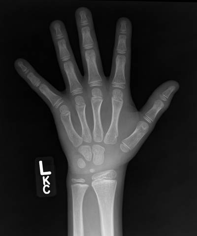 Sample image from RSNA Bone Age 2017
