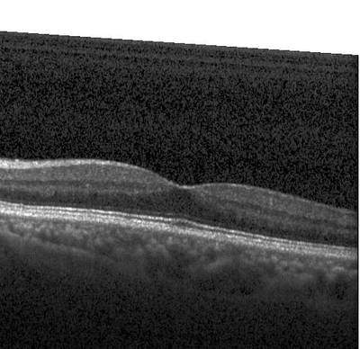 Sample image from ZhangLabData: OCT