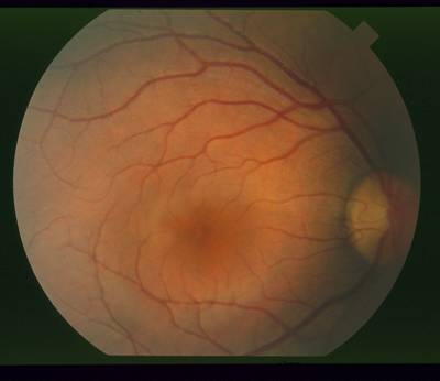 Sample image from STARE