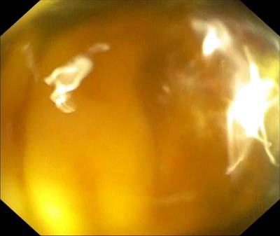 Sample image from PolypGen