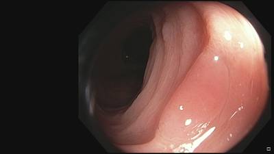 Sample image from Fine Grained Polyp