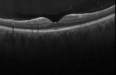 Sample image from ZhangLabData: OCT